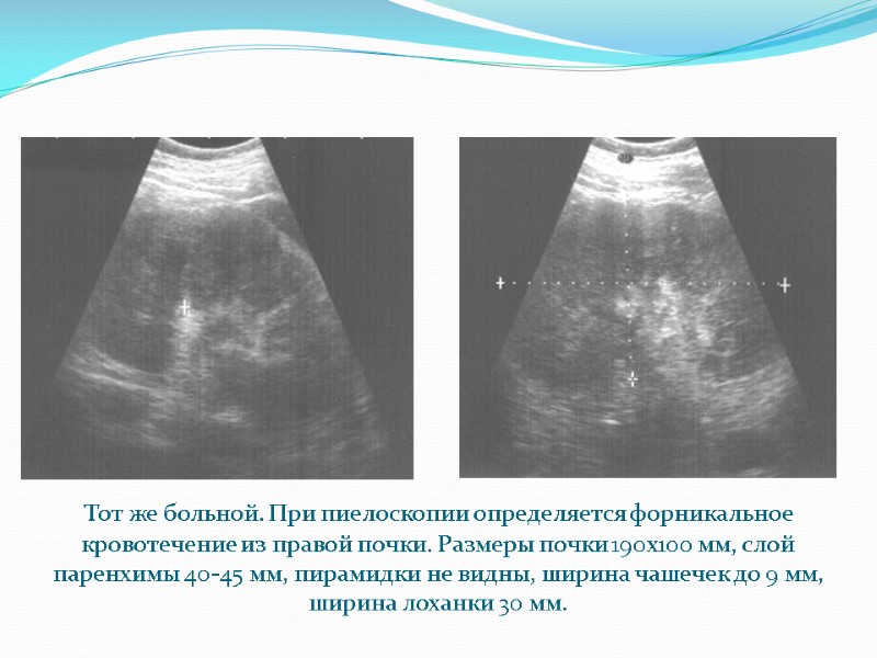 Тот же больной. При пиелоскопии определяется форникальное кровотечение из правой почки. Размеры почки 190х100